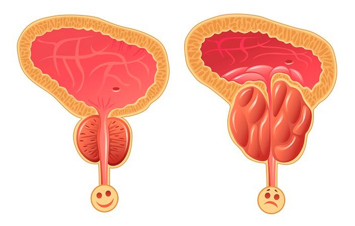 Prostate normale et enflammée.