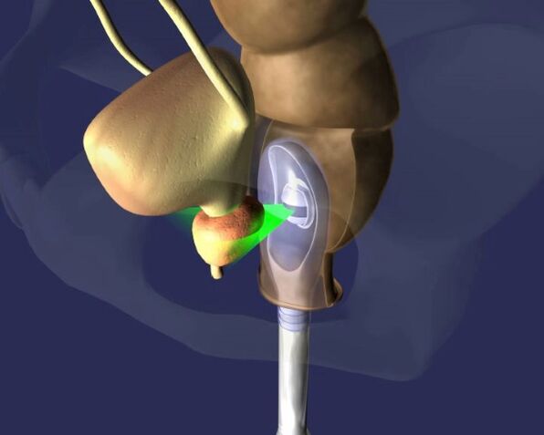 traitement par échographie de la prostate pour la prostatite