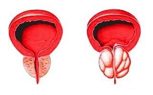 Prostate à l'état normal (à gauche) et enflammée par une prostatite (à droite)